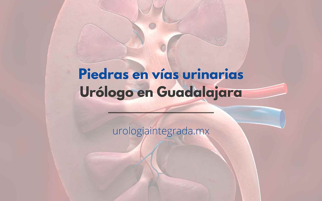 articulos piedras en vias urinarias. Urólogo en Guadalajara