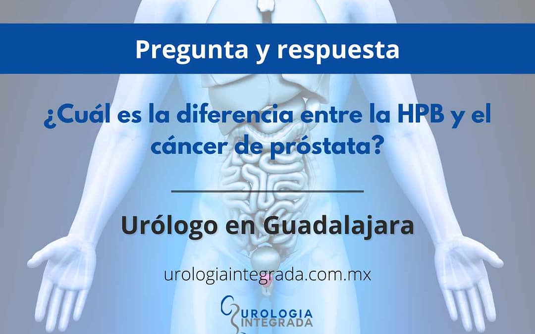 ¿Cuál es la diferencia entre la HPB y el cáncer de próstata?